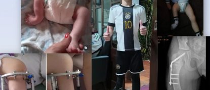 Arthur enfrenta a nona cirurgia e família cria campanha para ajudar no tratamento