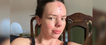 Após perder parte do nariz em acidente, moradora de SC agradece apoio após arrecadar valor para cirurgia reconstrutiva